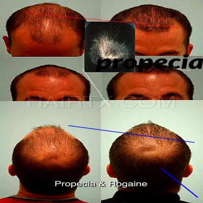 Finasteride ou propecia prix